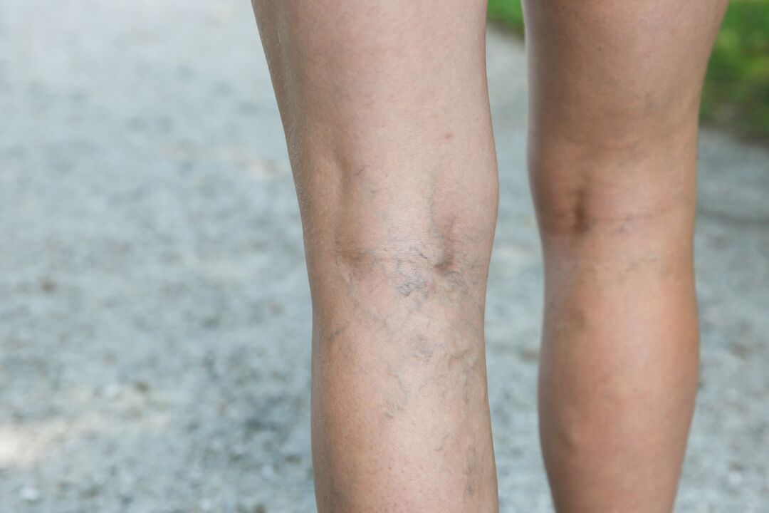 For varicose veins, an exercise program should be discussed with your doctor. 